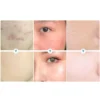 2022 Best Organic Whitening Herbal Tea Tree Oil Acne Spot Treatment Removing Anti Acne Face Cream - Image 2