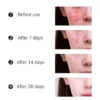 2022 Best Organic Whitening Herbal Tea Tree Oil Acne Spot Treatment Removing Anti Acne Face Cream - Image 3